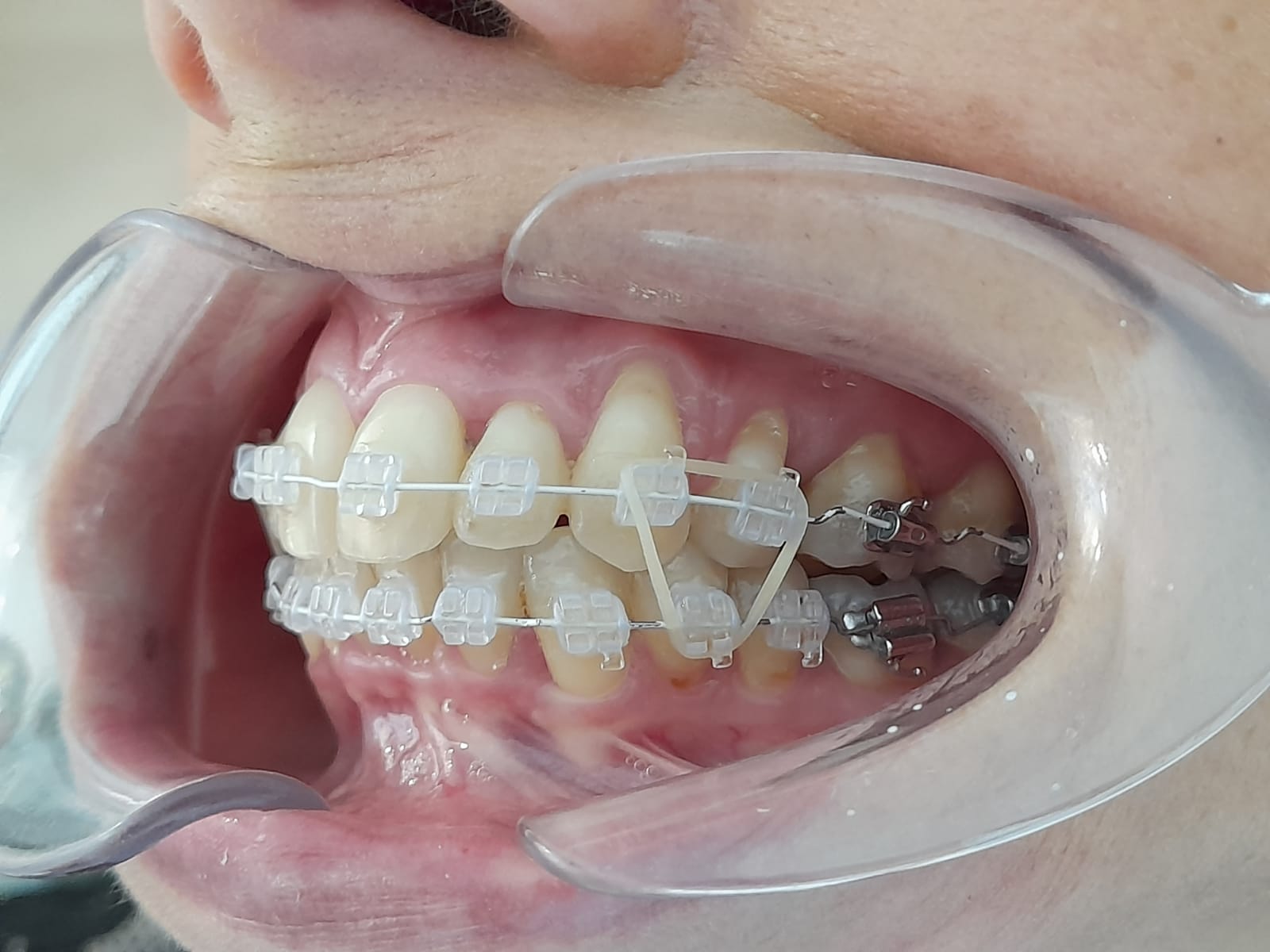 ALASTIC MEDIO PERLADO X 1.5MTS - Imagen 2